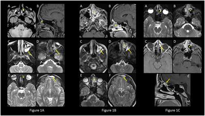 An adolescent girl with syndrome of inappropriate antidiuretic hormone secretion preceding the diagnosis of olfactory neuroblastoma – a case report